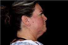 Facelift Before Photo by Landon Pryor, MD, FACS; Rockford, IL - Case 47625
