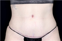 Tummy Tuck After Photo by Landon Pryor, MD, FACS; Rockford, IL - Case 47626