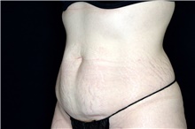 Tummy Tuck Before Photo by Landon Pryor, MD, FACS; Rockford, IL - Case 47626