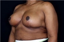 Breast Reduction After Photo by Landon Pryor, MD, FACS; Rockford, IL - Case 47627