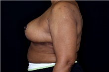 Breast Reduction After Photo by Landon Pryor, MD, FACS; Rockford, IL - Case 47627
