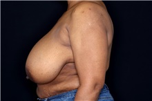 Breast Reduction Before Photo by Landon Pryor, MD, FACS; Rockford, IL - Case 47627