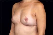 Breast Implant Removal After Photo by Landon Pryor, MD, FACS; Rockford, IL - Case 47629