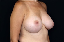 Breast Implant Removal Before Photo by Landon Pryor, MD, FACS; Rockford, IL - Case 47629