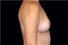 Breast Implant Removal After Photo by Landon Pryor, MD, FACS; Rockford, IL - Case 47629