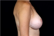 Breast Implant Removal Before Photo by Landon Pryor, MD, FACS; Rockford, IL - Case 47629
