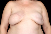 Breast Implant Removal Before Photo by Landon Pryor, MD, FACS; Rockford, IL - Case 47630