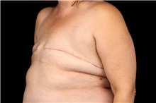 Breast Implant Removal After Photo by Landon Pryor, MD, FACS; Rockford, IL - Case 47630