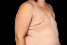 Breast Implant Removal After Photo by Landon Pryor, MD, FACS; Rockford, IL - Case 47630