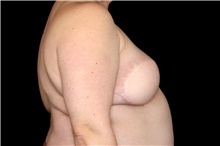Breast Implant Removal Before Photo by Landon Pryor, MD, FACS; Rockford, IL - Case 47630