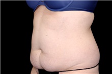 Tummy Tuck Before Photo by Landon Pryor, MD, FACS; Rockford, IL - Case 47693
