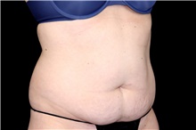 Tummy Tuck Before Photo by Landon Pryor, MD, FACS; Rockford, IL - Case 47693