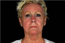 Facelift Before Photo by Landon Pryor, MD, FACS; Rockford, IL - Case 47694
