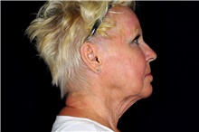 Facelift Before Photo by Landon Pryor, MD, FACS; Rockford, IL - Case 47694