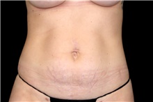 Liposuction After Photo by Landon Pryor, MD, FACS; Rockford, IL - Case 47695