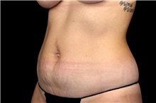 Liposuction Before Photo by Landon Pryor, MD, FACS; Rockford, IL - Case 47695