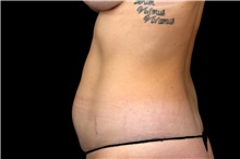Liposuction Before Photo by Landon Pryor, MD, FACS; Rockford, IL - Case 47695