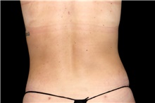 Liposuction After Photo by Landon Pryor, MD, FACS; Rockford, IL - Case 47695