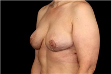 Breast Implant Removal After Photo by Landon Pryor, MD, FACS; Rockford, IL - Case 47697