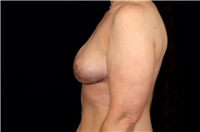 Breast Implant Removal After Photo by Landon Pryor, MD, FACS; Rockford, IL - Case 47697
