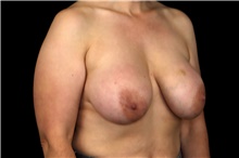 Breast Implant Removal Before Photo by Landon Pryor, MD, FACS; Rockford, IL - Case 47697