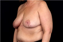 Breast Implant Removal After Photo by Landon Pryor, MD, FACS; Rockford, IL - Case 47698