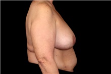 Breast Implant Removal After Photo by Landon Pryor, MD, FACS; Rockford, IL - Case 47698