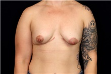 Breast Implant Removal After Photo by Landon Pryor, MD, FACS; Rockford, IL - Case 47699