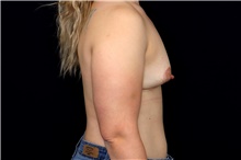 Breast Implant Removal After Photo by Landon Pryor, MD, FACS; Rockford, IL - Case 47699