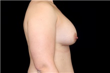 Breast Implant Removal Before Photo by Landon Pryor, MD, FACS; Rockford, IL - Case 47699