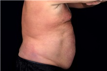 Liposuction Before Photo by Landon Pryor, MD, FACS; Rockford, IL - Case 47700