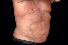 Liposuction After Photo by Landon Pryor, MD, FACS; Rockford, IL - Case 47700