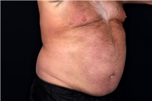 Liposuction Before Photo by Landon Pryor, MD, FACS; Rockford, IL - Case 47700