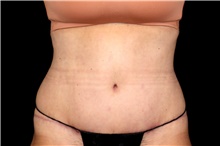 Steely Plastic Surgery - Before & After: Patient had a tummy tuck