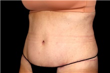 Tummy Tuck After Photo by Landon Pryor, MD, FACS; Rockford, IL - Case 47701
