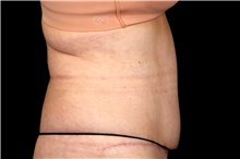 Tummy Tuck After Photo by Landon Pryor, MD, FACS; Rockford, IL - Case 47701