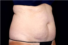 Tummy Tuck Before Photo by Landon Pryor, MD, FACS; Rockford, IL - Case 47701