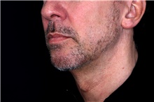 Injectable Fillers After Photo by Landon Pryor, MD, FACS; Rockford, IL - Case 47703