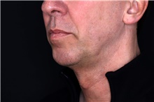 Injectable Fillers Before Photo by Landon Pryor, MD, FACS; Rockford, IL - Case 47703