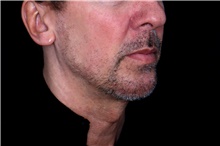 Injectable Fillers After Photo by Landon Pryor, MD, FACS; Rockford, IL - Case 47703