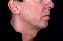 Injectable Fillers Before Photo by Landon Pryor, MD, FACS; Rockford, IL - Case 47703