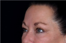 Eyelid Surgery After Photo by Landon Pryor, MD, FACS; Rockford, IL - Case 47704