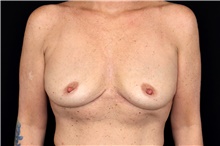 Breast Implant Removal After Photo by Landon Pryor, MD, FACS; Rockford, IL - Case 47706