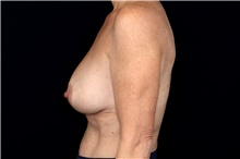 Breast Implant Removal Before Photo by Landon Pryor, MD, FACS; Rockford, IL - Case 47706
