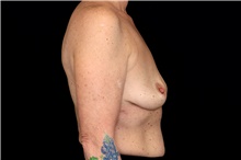Breast Implant Removal After Photo by Landon Pryor, MD, FACS; Rockford, IL - Case 47706