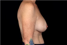 Breast Implant Removal Before Photo by Landon Pryor, MD, FACS; Rockford, IL - Case 47706