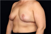 Breast Implant Removal After Photo by Landon Pryor, MD, FACS; Rockford, IL - Case 47707