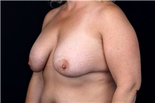 Breast Implant Removal Before Photo by Landon Pryor, MD, FACS; Rockford, IL - Case 47707
