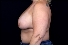 Breast Implant Removal Before Photo by Landon Pryor, MD, FACS; Rockford, IL - Case 47707