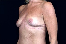 Breast Implant Removal After Photo by Landon Pryor, MD, FACS; Rockford, IL - Case 47709